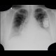 Cardiomyopathy, dilated cardiomyopathy: X-ray - Plain radiograph